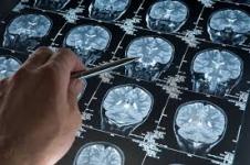 Ways to identify pediatric brain tumors early
								